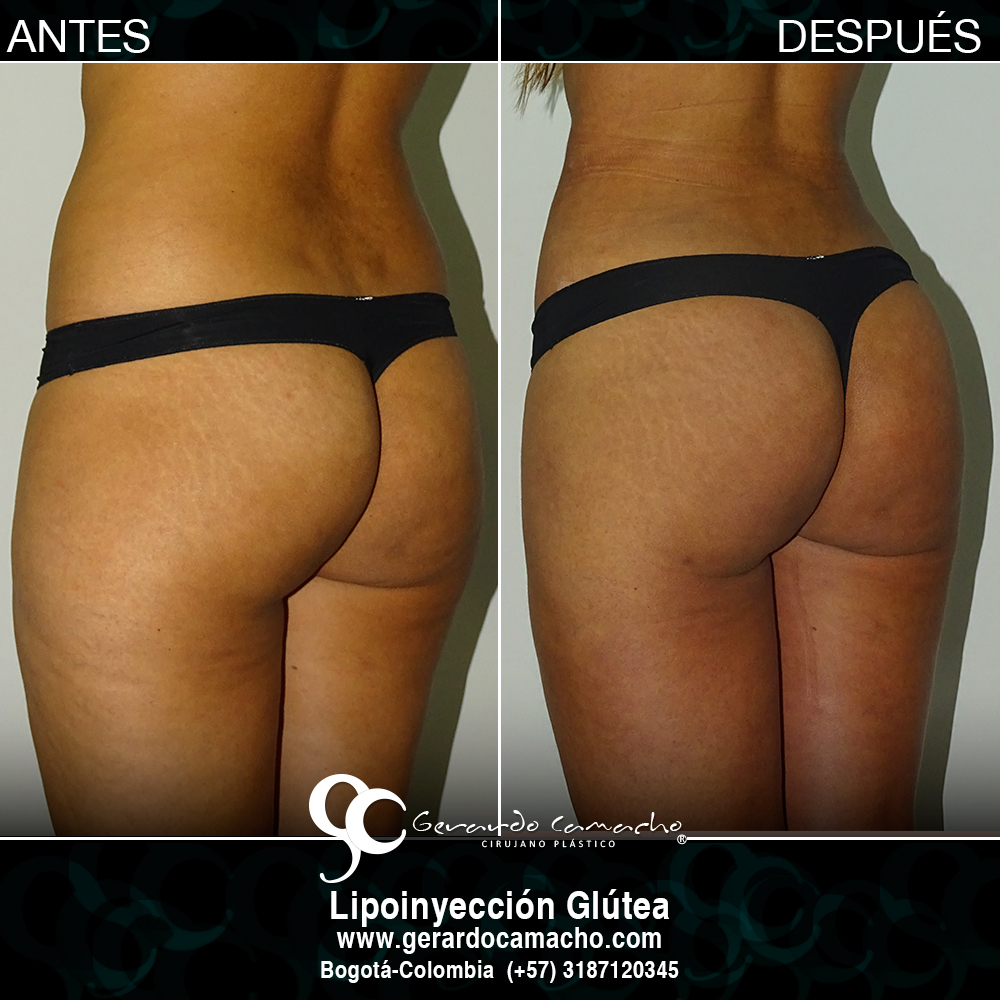 Testimonio gluteoplastia Gerardo Camacho